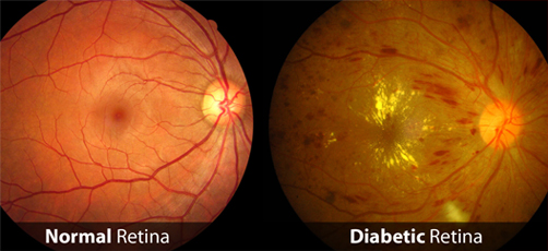 diabeticretinopathyimg.jpg